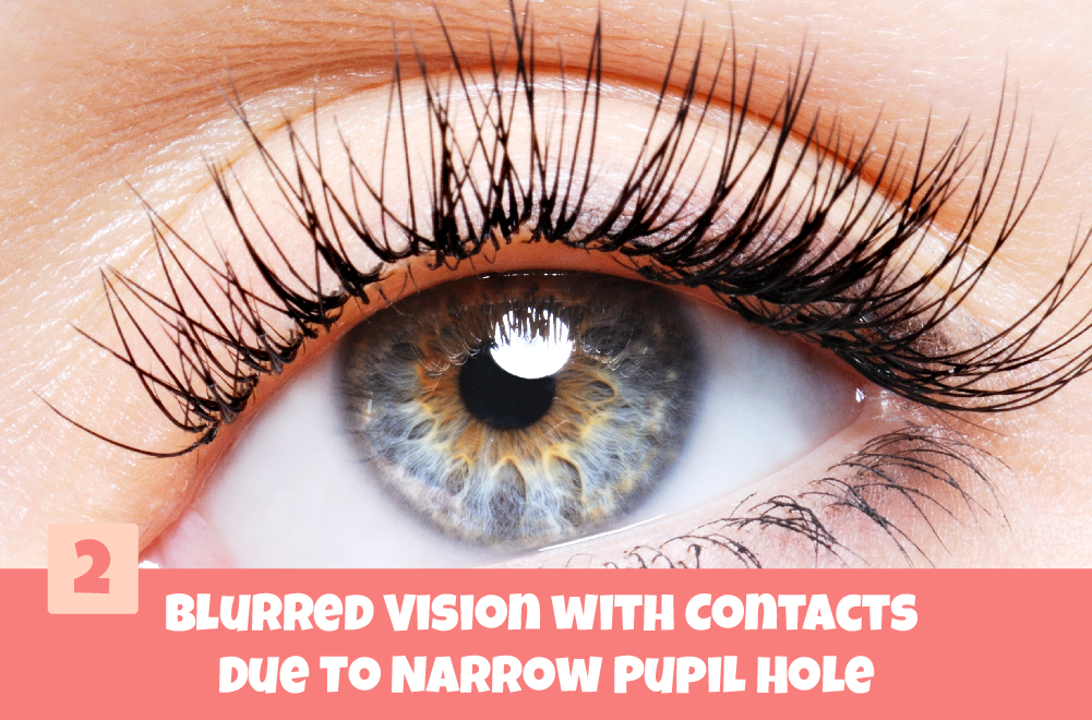 Contacts Blurry due to Narrow Pupil Hole