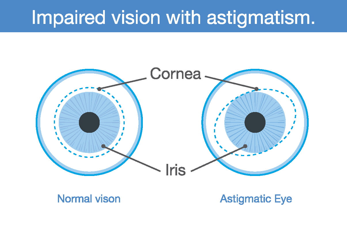 Astigmatic Eye