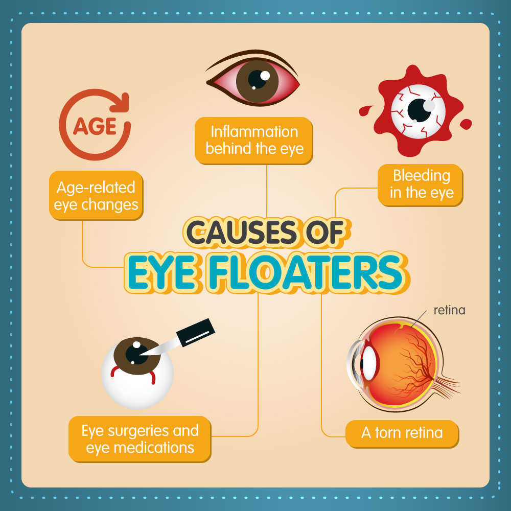 Dry eyes and floaters: Causes, treatment, and seeking help