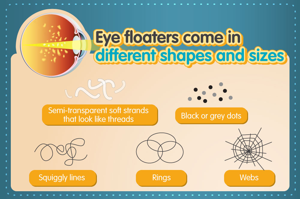 Wiggly Lines In Vision Causes - Infoupdate.org