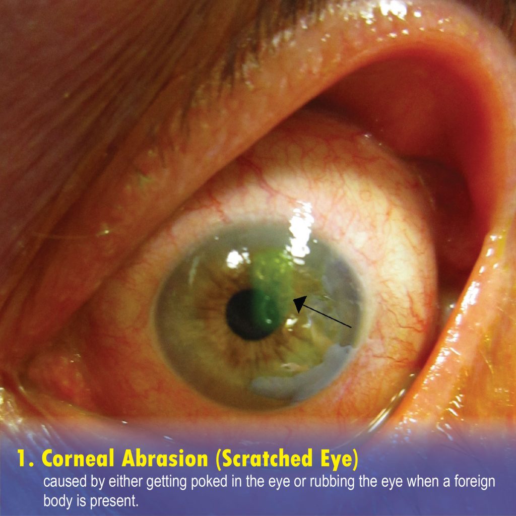 Corneal Abrasion (Scratched Eye)