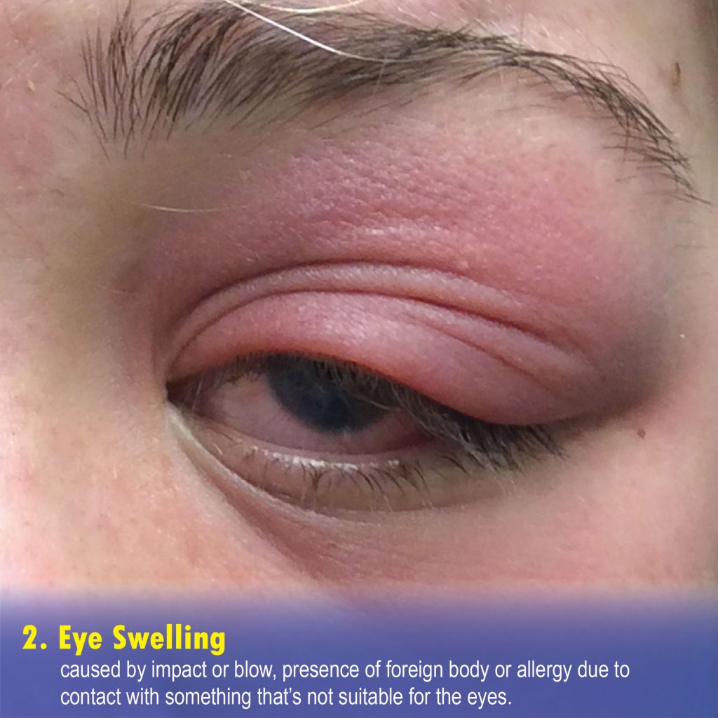 Eye Swelling