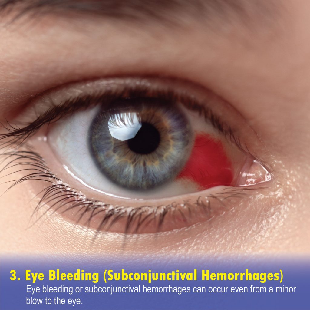 Eye Bleeding (Subconjunctival Hemorrhages)