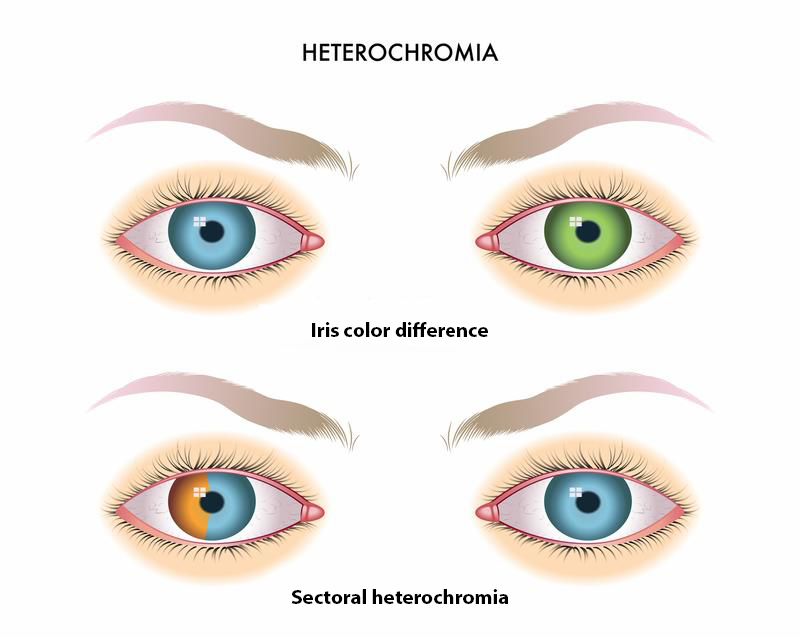 Heterochromia.