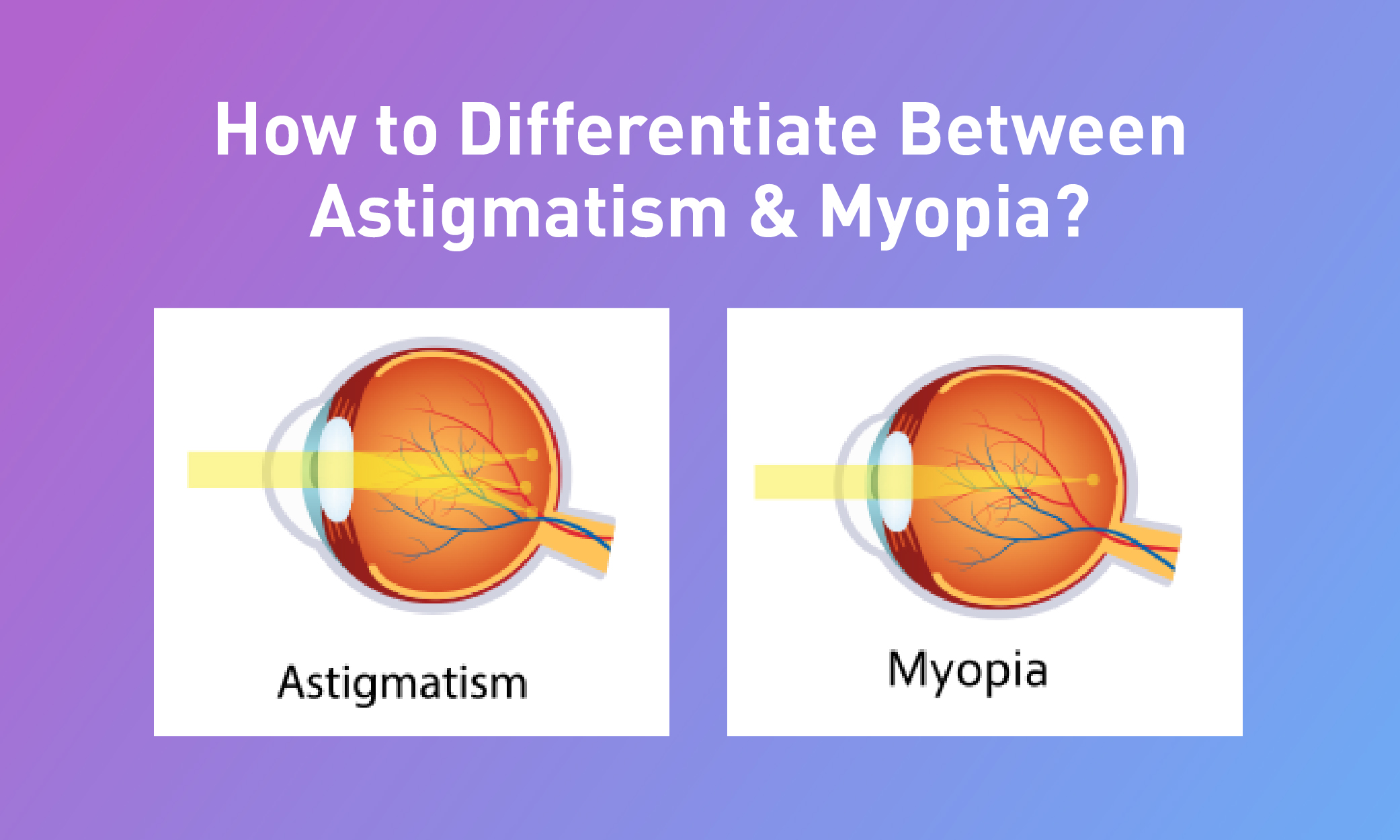 What Is Astigmatism & Everything You Need To Know — Uniqso