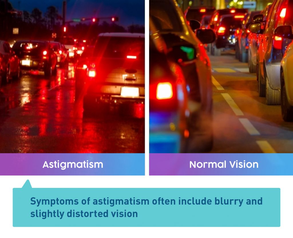 What Is Astigmatism Everything You Need to Know UNIQSO